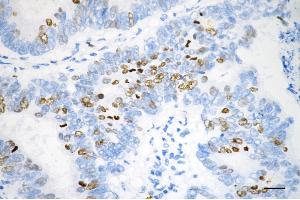 Immunohistochemistry was performed on paraffin-embedded human sigmoid colon carcinoma using DNA topoisomerase II alpha antibody (ABIN7800574), 1:200).