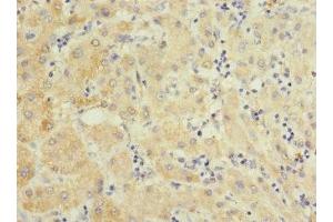 Immunohistochemistry of paraffin-embedded human liver cancer using ABIN7151102 at dilution of 1:100 (Pellino 3 抗体  (AA 1-280))