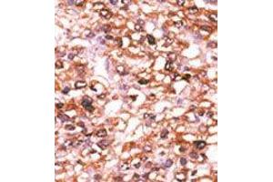 Formalin-fixed and paraffin-embedded human cancer tissue reacted with the primary antibody, which was peroxidase-conjugated to the secondary antibody, followed by AEC staining.