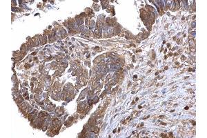 IHC-P Image LOXL2 antibody detects LOXL2 protein at cytosol on human ovarian carcinoma by immunohistochemical analysis. (LOXL2 抗体)