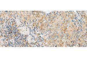Immunohistochemistry of paraffin-embedded Human cervical cancer tissue using CNPY3 Polyclonal Antibody at dilution of 1:55(x200) (TNRC5 抗体)