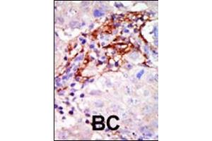 Formalin-fixed and paraffin-embedded human cancer tissue reacted with the primary antibody, which was peroxidase-conjugated to the secondary antibody, followed by AEC staining. (MAP2K3 抗体  (N-Term))