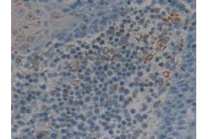 IHC-P analysis of Human Skin Cancer Tissue, with DAB staining. (CD25 抗体  (AA 22-213))
