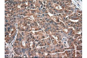 Immunohistochemical staining of paraffin-embedded Adenocarcinoma of colon using anti-NTF3 (ABIN2452548) mouse monoclonal antibody. (Neurotrophin 3 抗体  (AA 139-257))