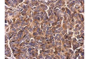 IHC-P Image Survivin antibody detects Survivin protein at cytosol on human breast carcinoma by immunohistochemical analysis. (Survivin 抗体)