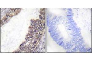 Immunohistochemistry analysis of paraffin-embedded human colon carcinoma, using GIRK1/KIR3. (KCNJ3 抗体  (pSer185))