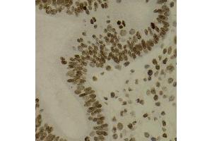 Immunohistochemistry of paraffin-embedded human uterine cancer using NFKB2 antibody at dilution of 1:200 (400x lens). (NFKB2 抗体)