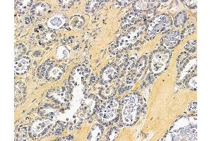 ABIN7096455 and ABIN7100519 at 1/100 staining human ovarian cancer by IHC-P.