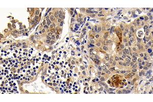 Detection of Bcl2L in Human Lymphoma Tissue using Monoclonal Antibody to B-Cell CLL/Lymphoma 2 Like Protein (Bcl2L) (BCL2L1 抗体  (AA 2-212))
