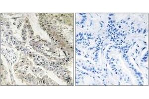 Immunohistochemistry analysis of paraffin-embedded human lung carcinoma tissue, using CRBP III Antibody.