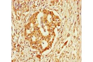 Immunohistochemistry of paraffin-embedded human pancreatic cancer using ABIN7152927 at dilution of 1:100 (FBLN7 抗体  (AA 25-393))