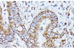 Immunohistochemistry of paraffin-embedded Human colon carcinoma using PPP2CB Polyclonal Antibody at dilution of 1:100 (40x lens). (PPP2CB 抗体)