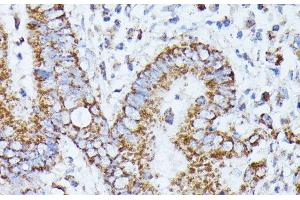 Immunohistochemistry of paraffin-embedded Human colon carcinoma using PPP2CB Polyclonal Antibody at dilution of 1:100 (40x lens). (PPP2CB 抗体)