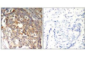 Immunohistochemical analysis of paraffin-embedded human breast carcinoma tissue using SAPK/JNK (Ab-183) Antibody (E021241). (SAPK, JNK 抗体)
