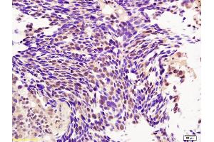 Formalin-fixed and paraffin embedded human lung carcinoma labeled with Rabbit Anti BMI1/PCGF4 Polyclonal Antibody, Unconjugated (ABIN682678) at 1:200 followed by conjugation to the secondary antibody and DAB staining (BMI1 抗体  (AA 61-160))