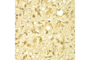 Immunohistochemistry of paraffin-embedded human brain cancer using SPAG16 antibody at dilution of 1:100 (x400 lens). (SPAG16 抗体)