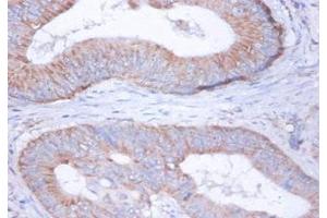 Immunohistochemistry of paraffin-embedded human colon cancer using ABIN7149114 at dilution of 1:100 (UQCRFS1 抗体  (AA 79-274))