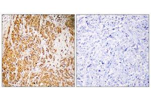 Immunohistochemistry analysis of paraffin-embedded human breast carcinoma tissue, using ZSCAN22 antibody. (ZSCAN22 抗体  (Internal Region))