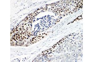 IHC-P: p63 antibody testing of human esophageal squamous cell carcinoma tissue
