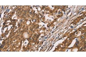 Immunohistochemistry of paraffin-embedded Human gasrtic cancer tissue using DICER1 Polyclonal Antibody at dilution 1:40 (DICER1 抗体)