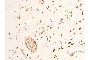 ABIN6267253 at 1/100 staining human glioma tissue sections by IHC-P.