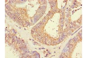 Immunohistochemistry of paraffin-embedded human endometrial cancer using ABIN7151005 at dilution of 1:100