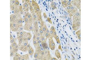 Immunohistochemistry of paraffin-embedded Human liver cancer using ALG2 Polyclonal Antibody at dilution of 1:100 (40x lens). (ALG2 抗体)