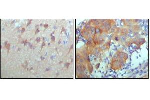 Immunohistochemical analysis of paraffin-embedded human cerebra (left) and breast carcinoma tissue (right),showing cytoplasmic and membrane location with DAB staining using ERBB3 mouse mAb.