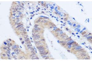 Immunohistochemistry of paraffin-embedded Human colon carcinoma using RBM39 Polyclonal Antibody at dilution of 1:100 (40x lens). (RBM39 抗体)