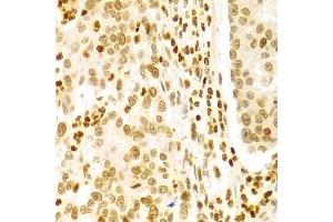 Immunohistochemistry of paraffin-embedded human gastric cancer using DKC1 Antibody (ABIN5970956) at dilution of 1/100 (40x lens). (DKC1 抗体)