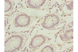 Immunohistochemistry of paraffin-embedded human colon cancer using ABIN7167697 at dilution of 1:100 (RPA2 抗体  (AA 1-267))