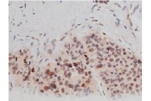 ABIN6267361 at 1/200 staining Human liver cancer tissue sections by IHC-P. (MAPT 抗体  (pThr181))