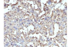 Formalin-fixed, paraffin-embedded human Histiocytoma stained with TNF alpha Rabbit Recombinant Monoclonal Antibody (TNF/1500R). (Recombinant TNF alpha 抗体)