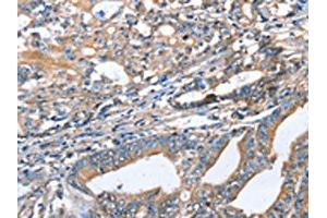 The image on the left is immunohistochemistry of paraffin-embedded Human gastric cancer tissue using ABIN7128332(AKR1D1 Antibody) at dilution 1/35, on the right is treated with fusion protein. (AKR1D1 抗体)