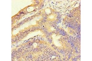 Immunohistochemistry of paraffin-embedded human colon cancer using ABIN7171536 at dilution of 1:100 (TAS2R13 抗体  (AA 150-184))