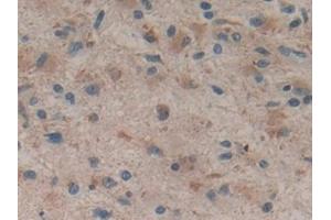 Detection of HMGCS in Human Glioma Tissue using Polyclonal Antibody to Hydroxymethylglutaryl Coenzyme A Synthase (HMGCS) (HMGCS1 抗体  (AA 293-467))