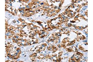 The image on the left is immunohistochemistry of paraffin-embedded Human thyroid cancer tissue using ABIN7129698(HINT2 Antibody) at dilution 1/40, on the right is treated with fusion protein. (HINT2 抗体)
