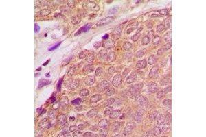 Immunohistochemical analysis of ASC staining in human breast cancer formalin fixed paraffin embedded tissue section. (STS 抗体  (N-Term))