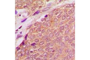 Immunohistochemical analysis of ASC staining in human breast cancer formalin fixed paraffin embedded tissue section.
