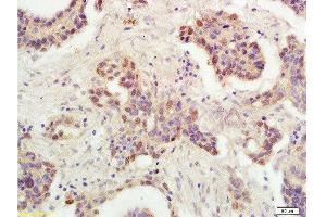 Formalin-fixed and paraffin embedded human ovarian carcinoma labeled with Rabbit Anti-P53 protein(wt-p53) Polyclonal Antibody , Unconjugated 1:300 followed by conjugation to the secondary antibody and DAB staining (p53 抗体  (AA 251-310))