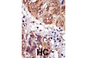 Formalin-fixed and paraffin-embedded human cancer tissue reacted with the primary antibody, which was peroxidase-conjugated to the secondary antibody, followed by DAB staining. (LIM Domain Kinase 1 抗体  (N-Term))