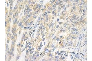 ABIN6265789 and ABIN6278090 at 1/100 staining human lung squamous cell carcinoma by IHC-P. (TUBA1B 抗体  (N-Term))