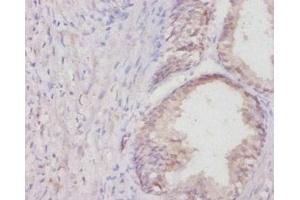 Immunohistochemistry of paraffin-embedded human colon cancer using ABIN7178837 at dilution of 1:20 (COL1A1 抗体  (AA 955-1207))