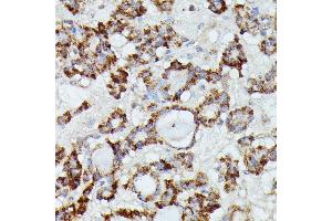 Immunohistochemistry of paraffin-embedded human thyroid cancer using MANBA antibody (ABIN7268392) at dilution of 1:100 (40x lens).