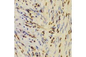 Immunohistochemistry of paraffin-embedded human adenomyosis using XRCC5 Antibody.
