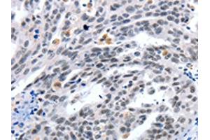 The image on the left is immunohistochemistry of paraffin-embedded Human ovarian cancer tissue using ABIN7191321(LRP5 Antibody) at dilution 1/55, on the right is treated with synthetic peptide.