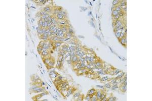 Immunohistochemistry of paraffin-embedded human gastric carcinoma using MBL2 antibody (ABIN6132334, ABIN6143597, ABIN6143600 and ABIN6221519) at dilution of 1:100 (40x lens). (MBL2 抗体  (AA 21-248))