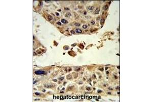Formalin-fixed and paraffin-embedded human hepatocarcinoma reacted with HPD Antibody (C-term), which was peroxidase-conjugated to the secondary antibody, followed by DAB staining. (HPD 抗体  (C-Term))