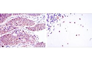 Immunohistochemical analysis of paraffin-embedded ovarian cancer (left) and cerebellum tissues (right) using MSI2 mouse mAb with DAB staining. (MSI2 抗体)