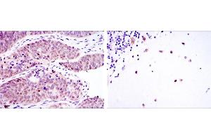 Immunohistochemical analysis of paraffin-embedded ovarian cancer (left) and cerebellum tissues (right) using MSI2 mouse mAb with DAB staining.